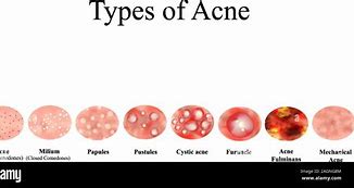 Image result for Infected Acne Pustules