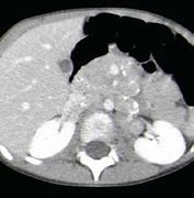 Image result for Neuropil Medulloblastoma