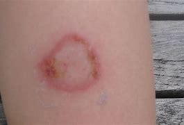 Image result for Raised Circular Lesion On Skin