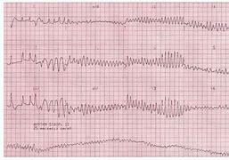 Image result for Ventricular Fibrillation Symptom