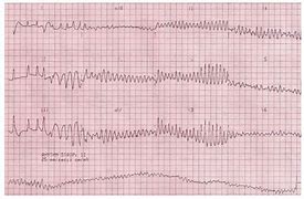 Image result for Ventricular Flutter and Fibrillation