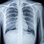 Image result for Asthma Chest X-Ray