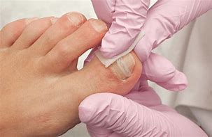 Image result for Ingrown Nail