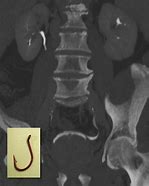 Image result for J-shaped Ureter