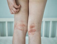 Image result for Atrophy Dermatology