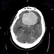 Image result for Subfalcine Meningioma CT