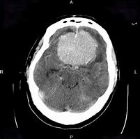 Image result for Meningioma CT Head