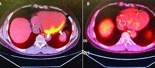 Image result for Pet Scan Glucose