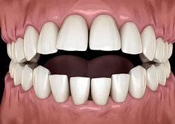 Image result for Mouth Bite