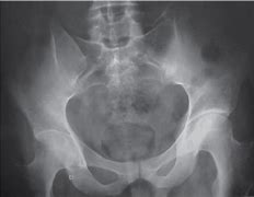 Image result for Hip Joint Space Narrowing