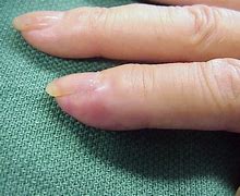 Image result for Cancer On Finger