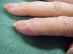 Image result for Finger Cancer