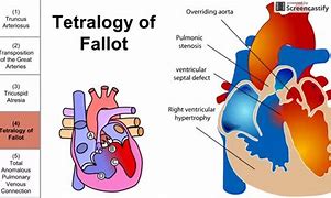 Image result for Cyanotic Heart Defect