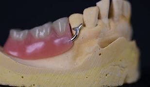 Image result for partial denture clasps materials