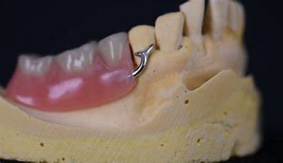 Image result for Partial Denture Clasps