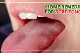 Image result for Open Sore On Tongue