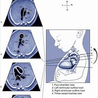 Image result for LVOT Rvot Ultrasound