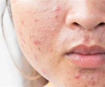 Image result for Acne Scars Home Remedy