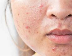 Image result for How to Get Rid Acne Bumps