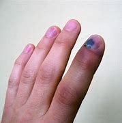 Image result for Smashed Tip of Pinky Finger