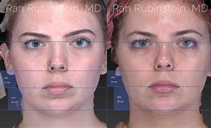 Image result for 1 Ml Chin Filler