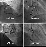 Image result for Angio Vue Choriocapillaris