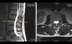 Image result for Lumbar Spine MRI Meme