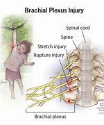 Image result for Brachial Plexus Fall Injury