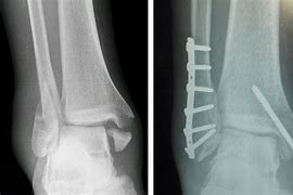 Image result for Open Ankle Fracture