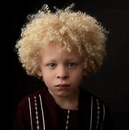 Image result for Albino Child