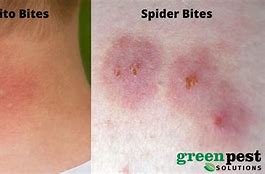 Image result for Spider Rash