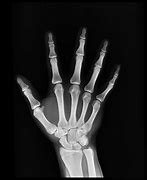 Image result for PA Finger X-ray