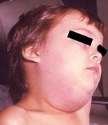 Image result for Mumps Child