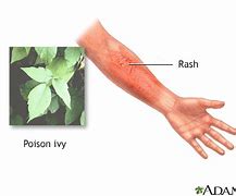 Image result for Poison Ivy Oak Sumac Rash