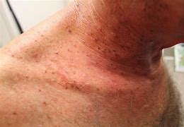 Image result for Skin Cancer On Back of Neck