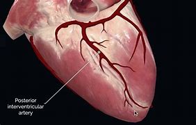 Image result for Posterior Interventricular Sulcus