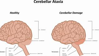 Image result for Cerebral Ataxia