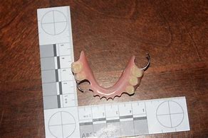 Image result for Acrylic Denture with Wrought Wire Clasps