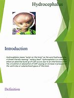 Image result for Hydrocephalus Concept Map