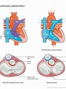 Image result for Tof with Atrioventricular Canal Defect