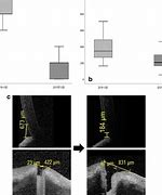 Image result for Punctal Stenosis