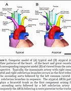 Image result for Retrocaval Artery