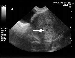 Image result for 3 Month Pregnancy Ultrasound