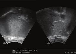 Image result for Biloma Ultrasound Images Post-Cholecystectomy