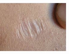 Image result for Atrophic Skin Aging