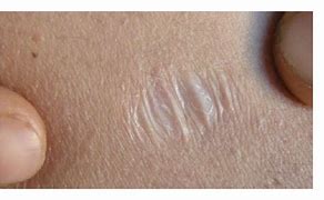 Image result for Atrophic Scar Treatment