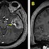 Image result for Aneurysm in MRI