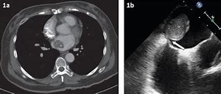 Image result for Cardiac Myxoma