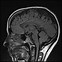 Image result for Brain MRI Angiogram