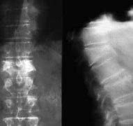 Image result for Compression Fracture Lumbar Surgery